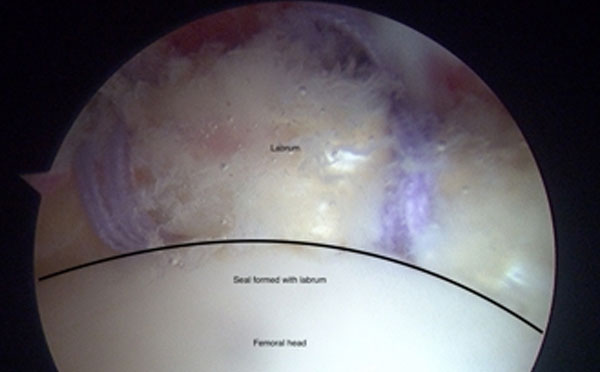 hip arthroscopy showing repaired labrum and CAM removed